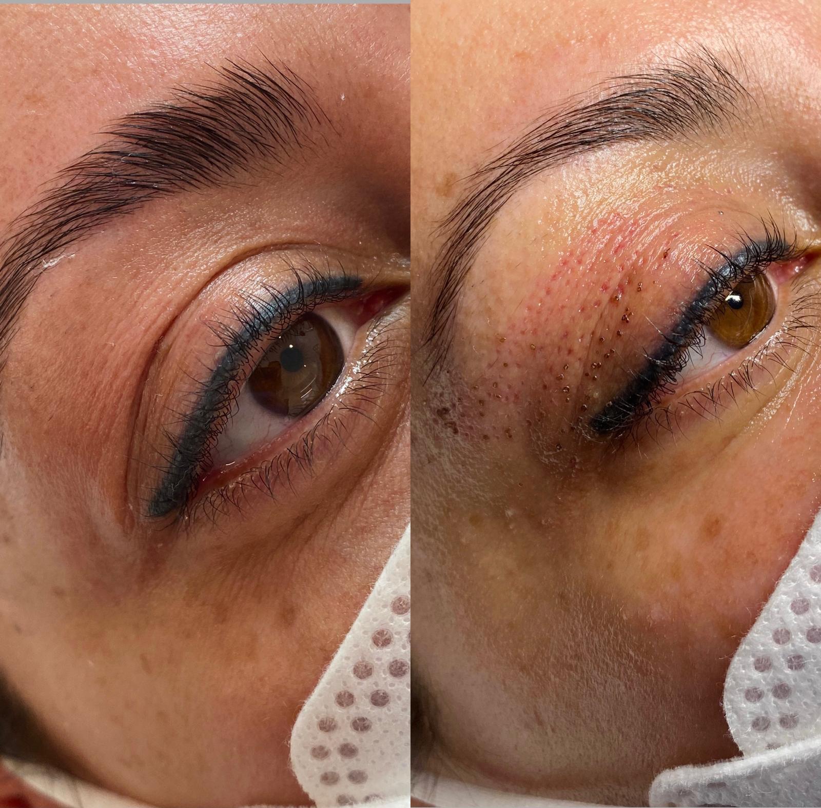 Augenpartie vor und nach der Plasma Pen Oberlidstraffung