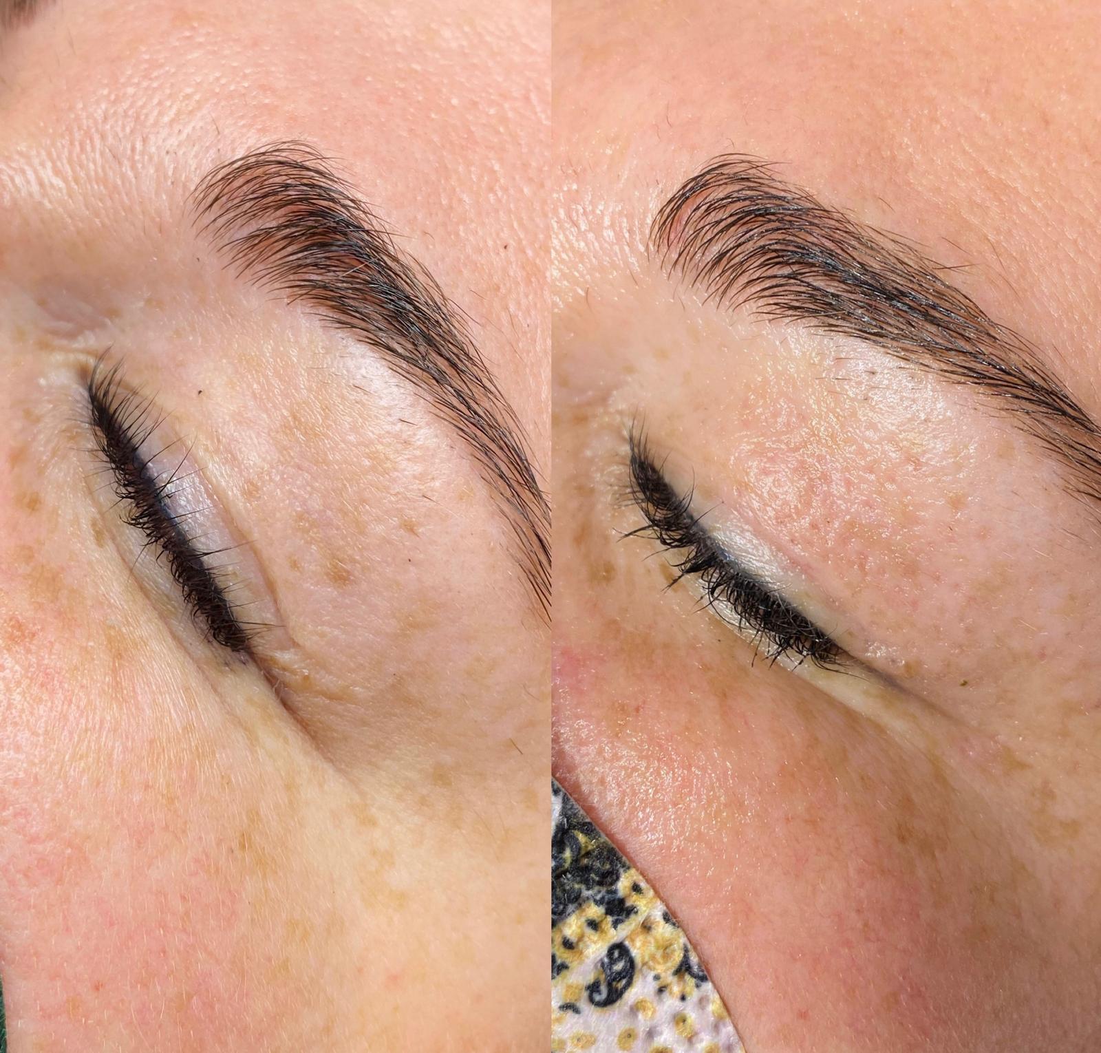 Oberlid vor und nach der Plasma Pen Behandlung