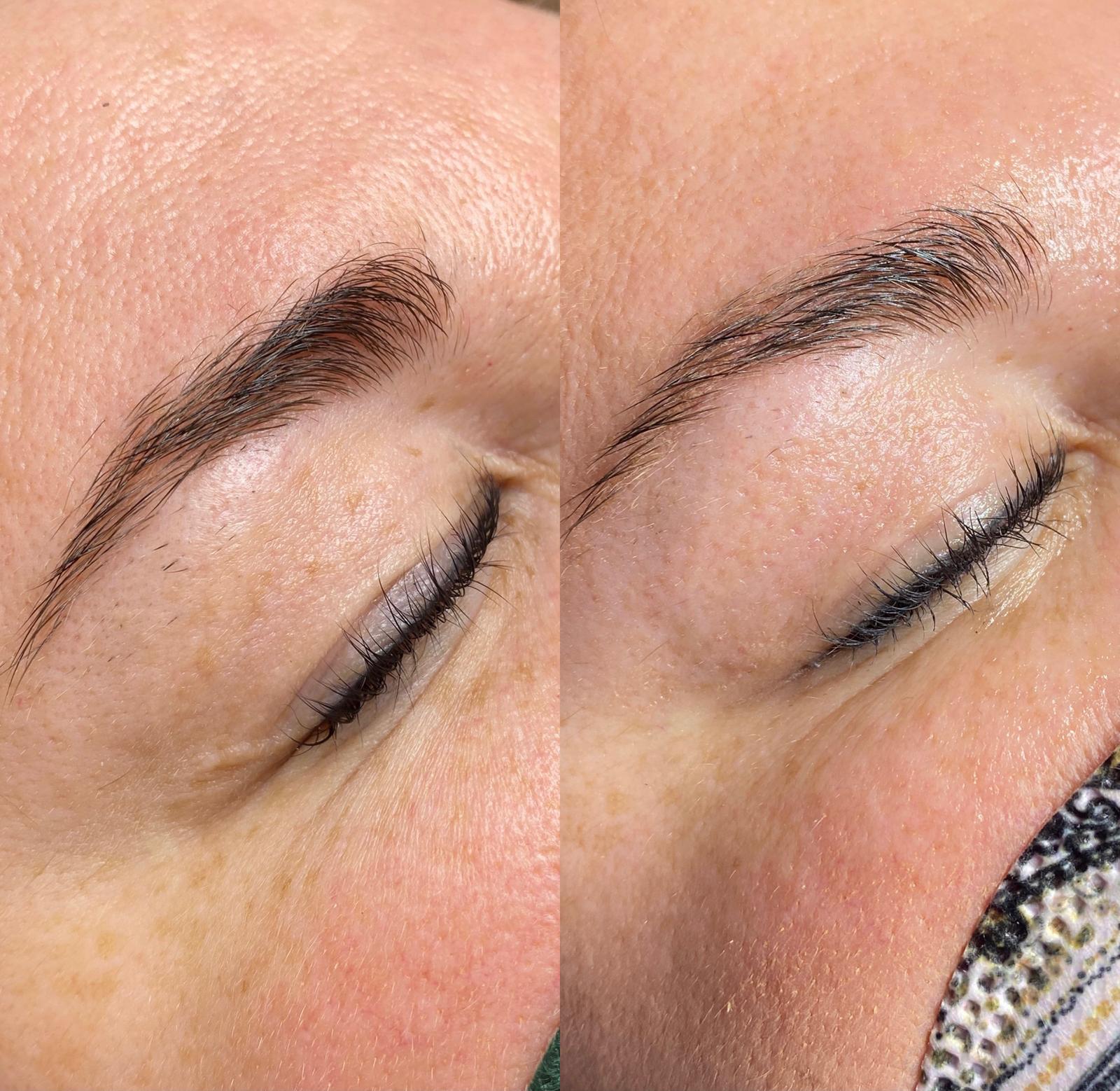 Oberlid vor und nach der Plasma Pen Behandlung